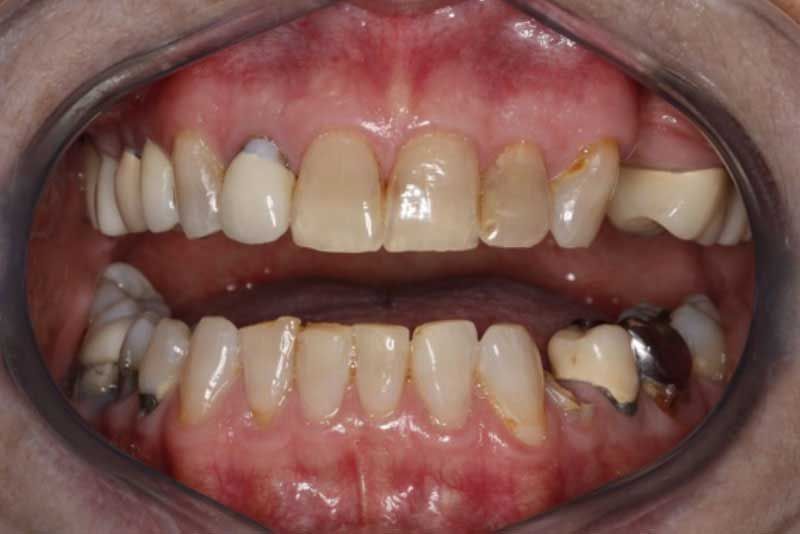 A close up of a person 's teeth in a mouth mirror.