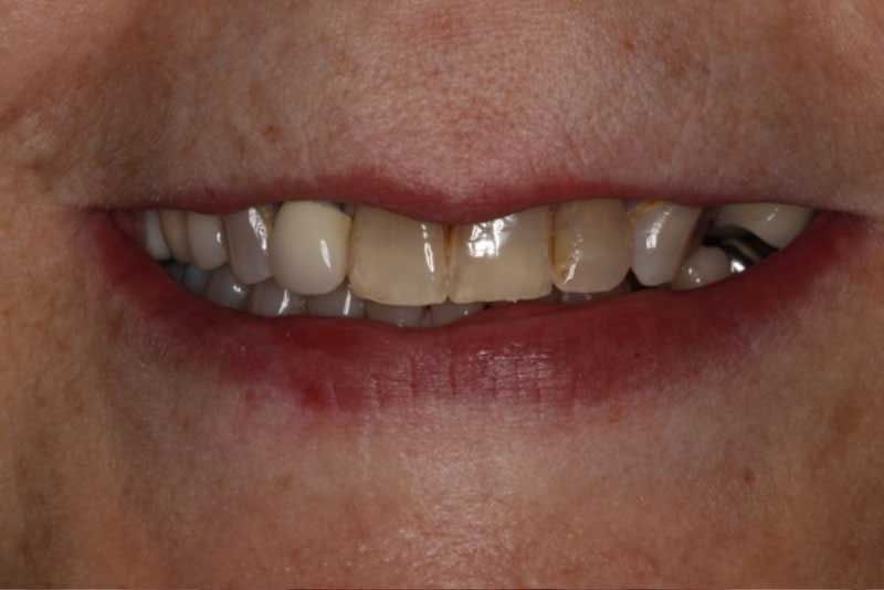 A close up of a person 's mouth with a broken tooth.