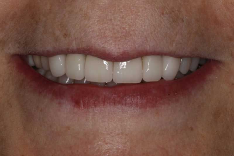 A close up of a woman 's smile with white teeth.