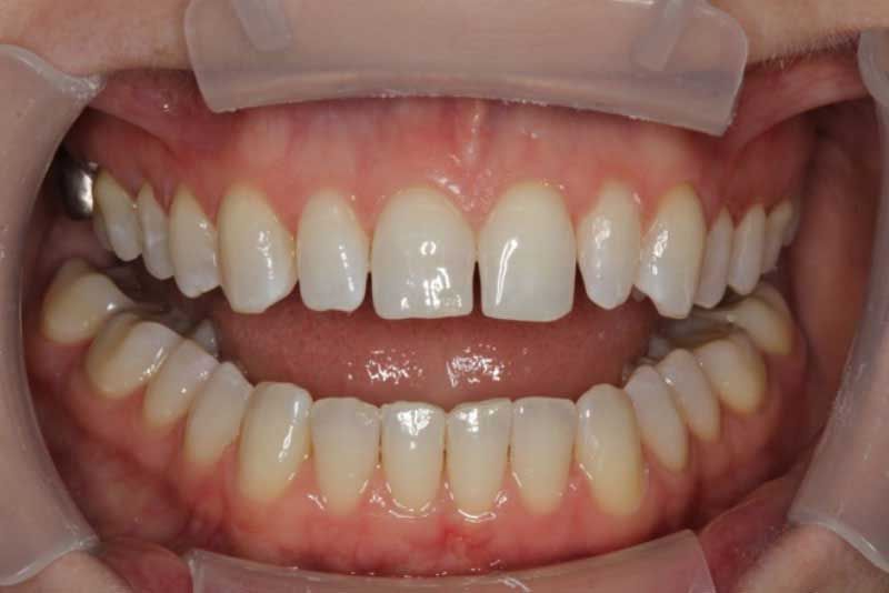 A close up of a person 's teeth with braces on them.