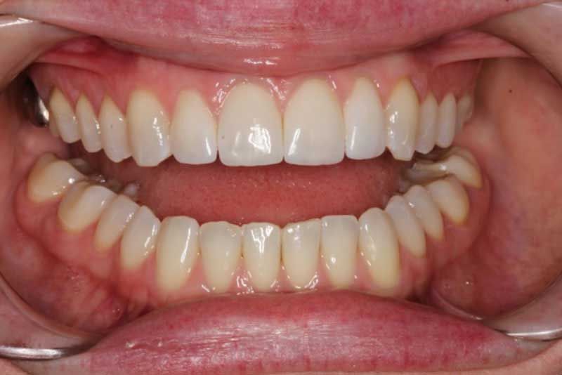 A close up of a person 's mouth with white teeth.