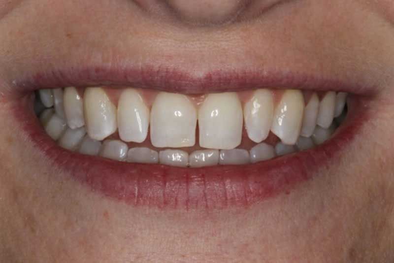 A close up of a woman 's smile with white teeth and red lips.