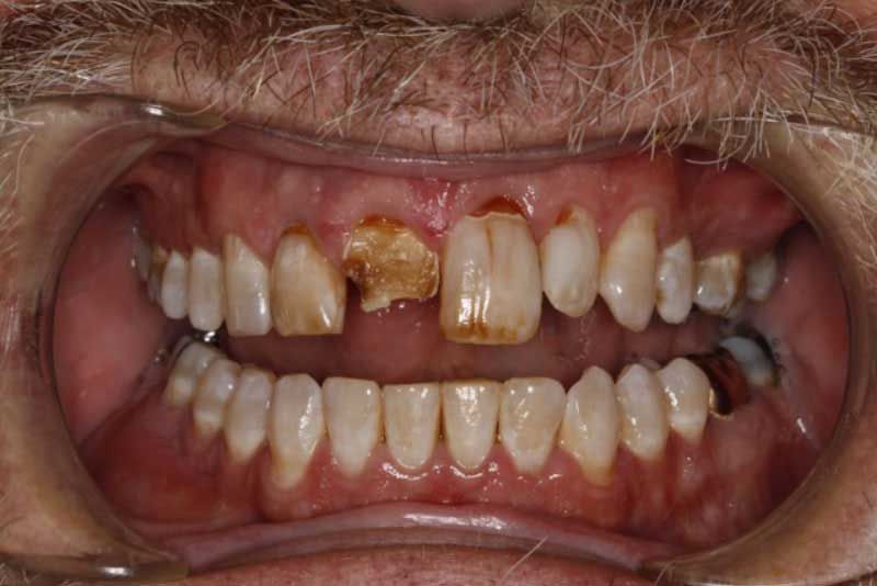A close up of a man 's mouth with missing teeth.