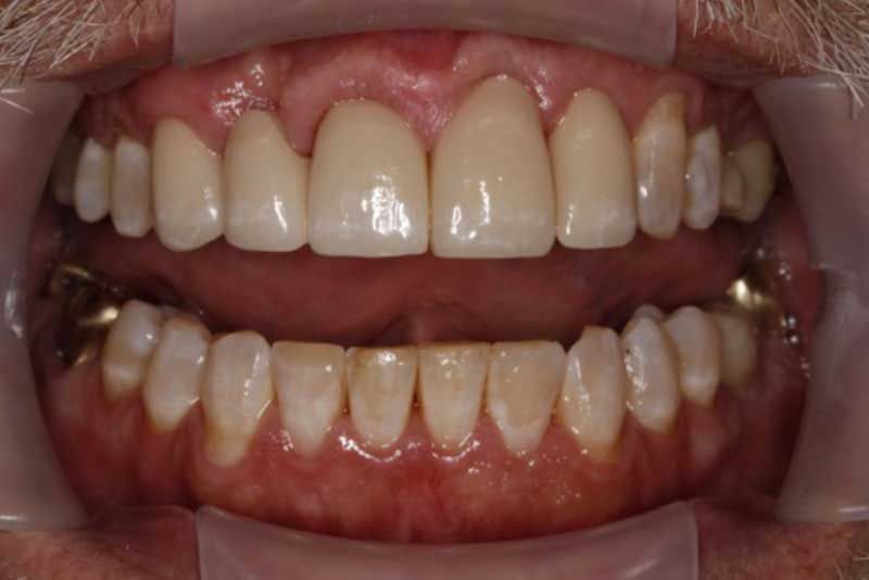 A close up of a man 's teeth with dental braces.