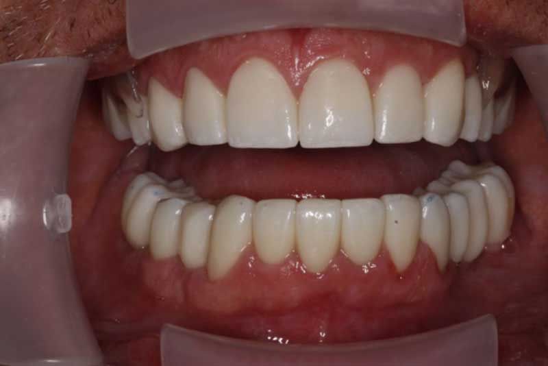 A close up of a person 's teeth with braces.