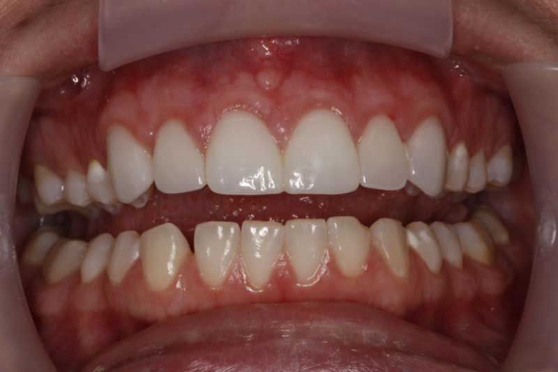 A close up of a person 's teeth with white teeth.