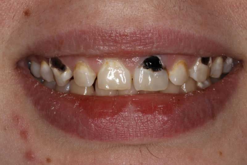 A close up of a person 's teeth with a lot of black spots on them.