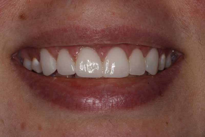 A close up of a woman 's smile with white teeth.
