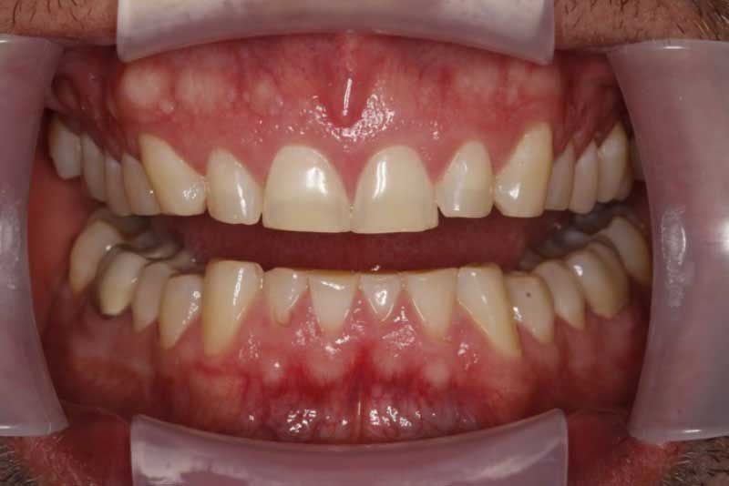 A close up of a person 's teeth with a mouth guard.