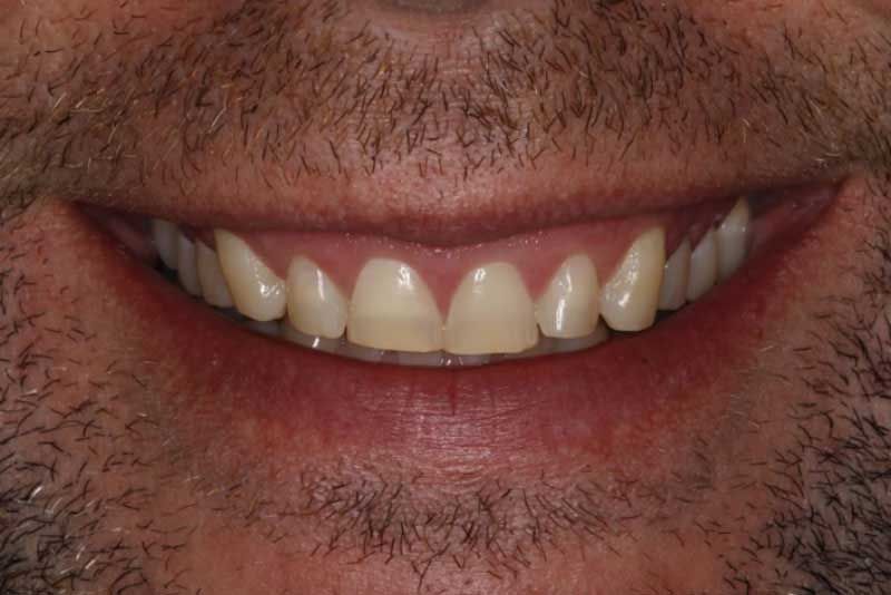 A close up of a man 's smile with a beard.