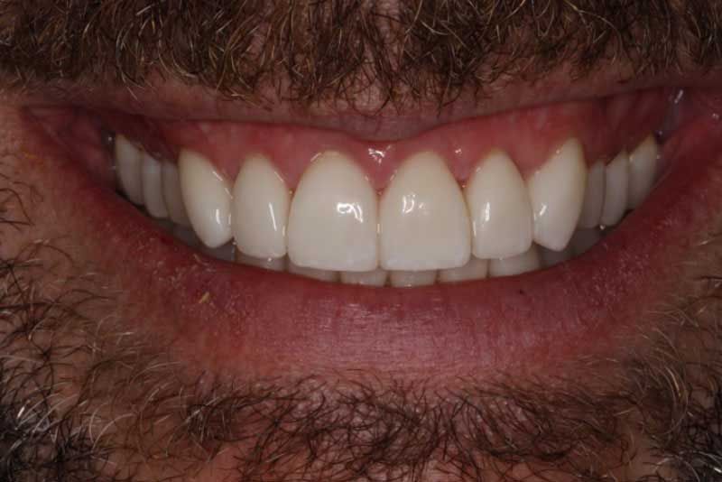 A close up of a man 's smile with white teeth and a beard.