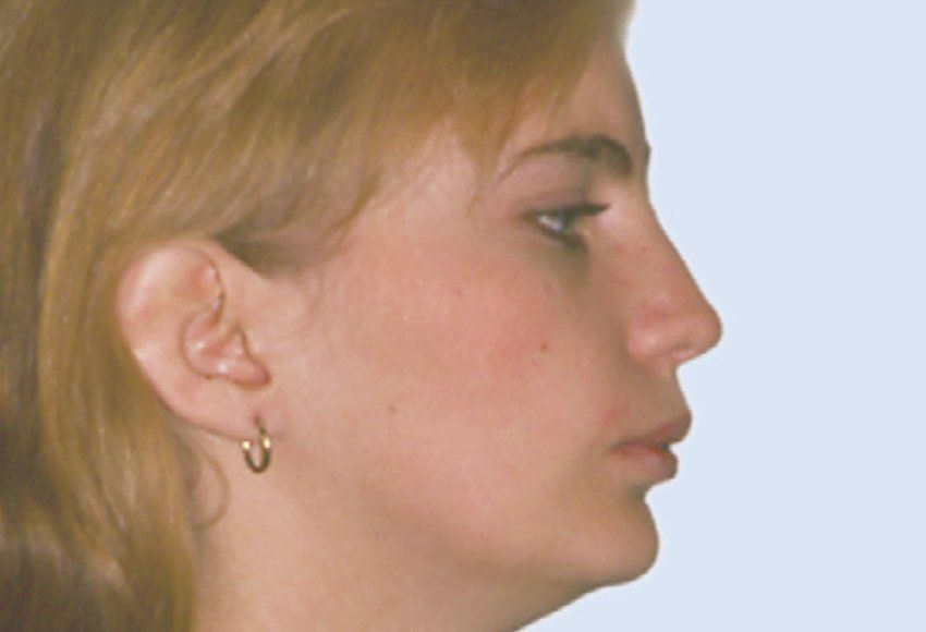 Protrusion (Class II)