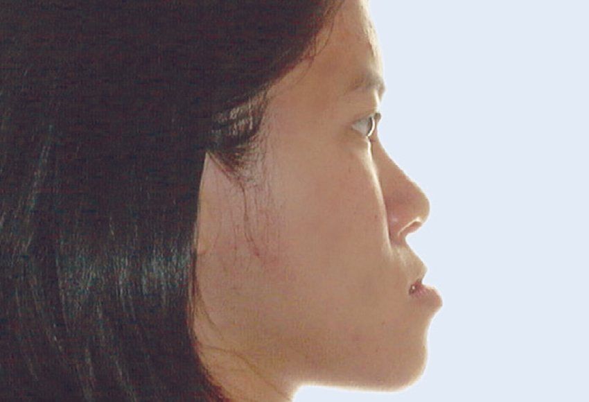 Underbite (Class III)