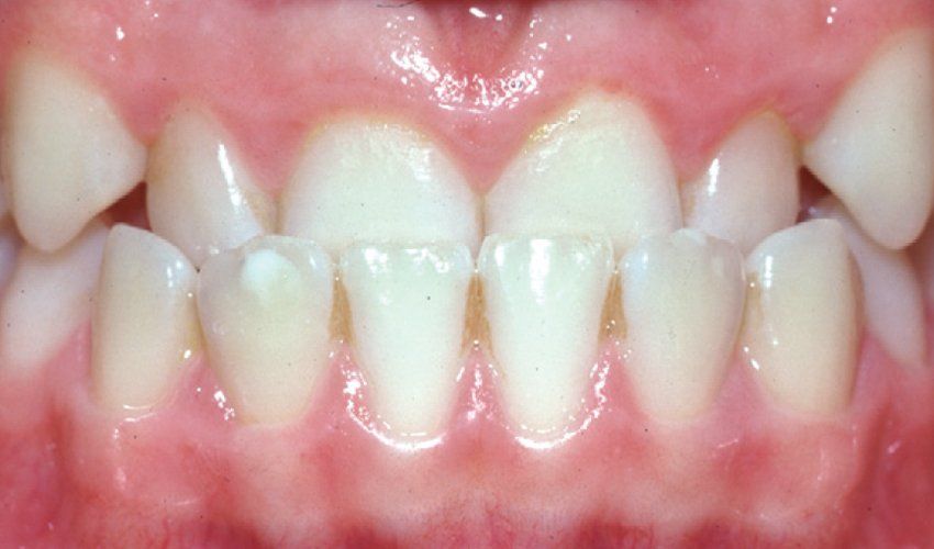 Anterior Crossbite
