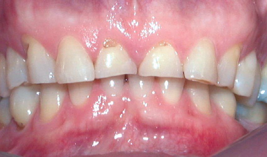 Tooth Wear/Bruxism