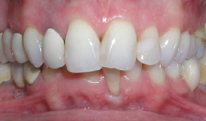Periodontal Problems