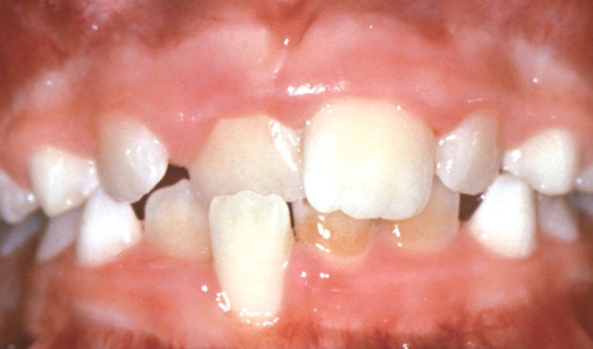 Crossbite of Front Teeth