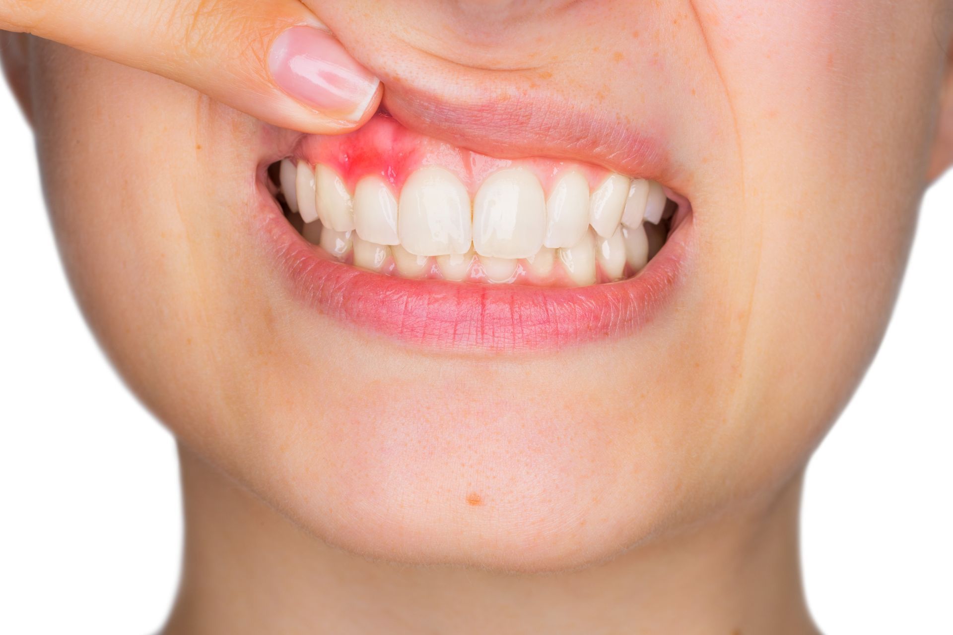 Person pulling up upper lip to show red, irritated gums above the front teeth