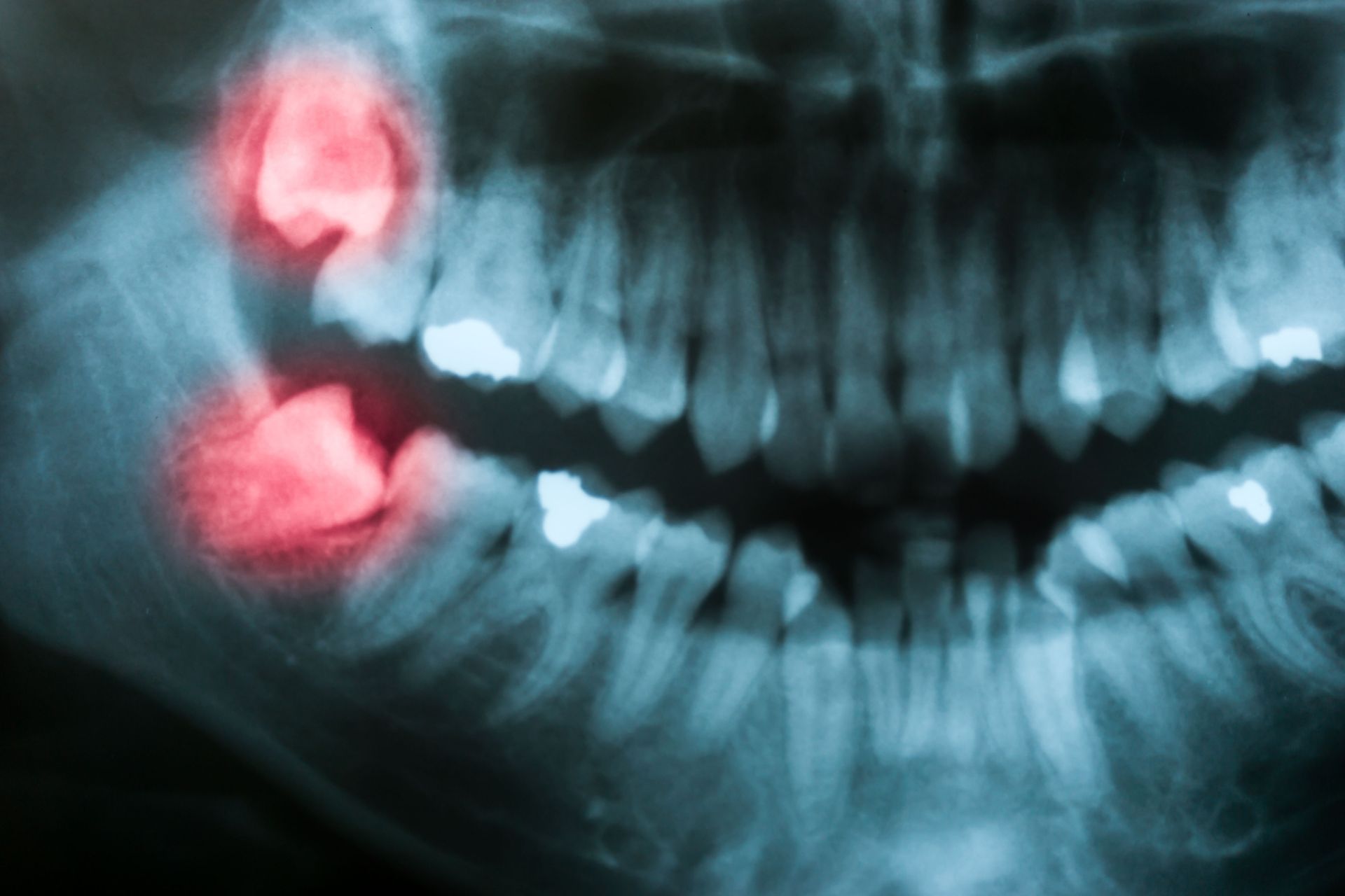 Blurred dental X-ray showing lower left molars circled in red highlight