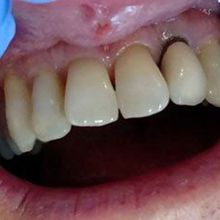 A close up of a person 's teeth with a blue glove on.