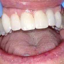 A close up of a person 's mouth with white teeth.