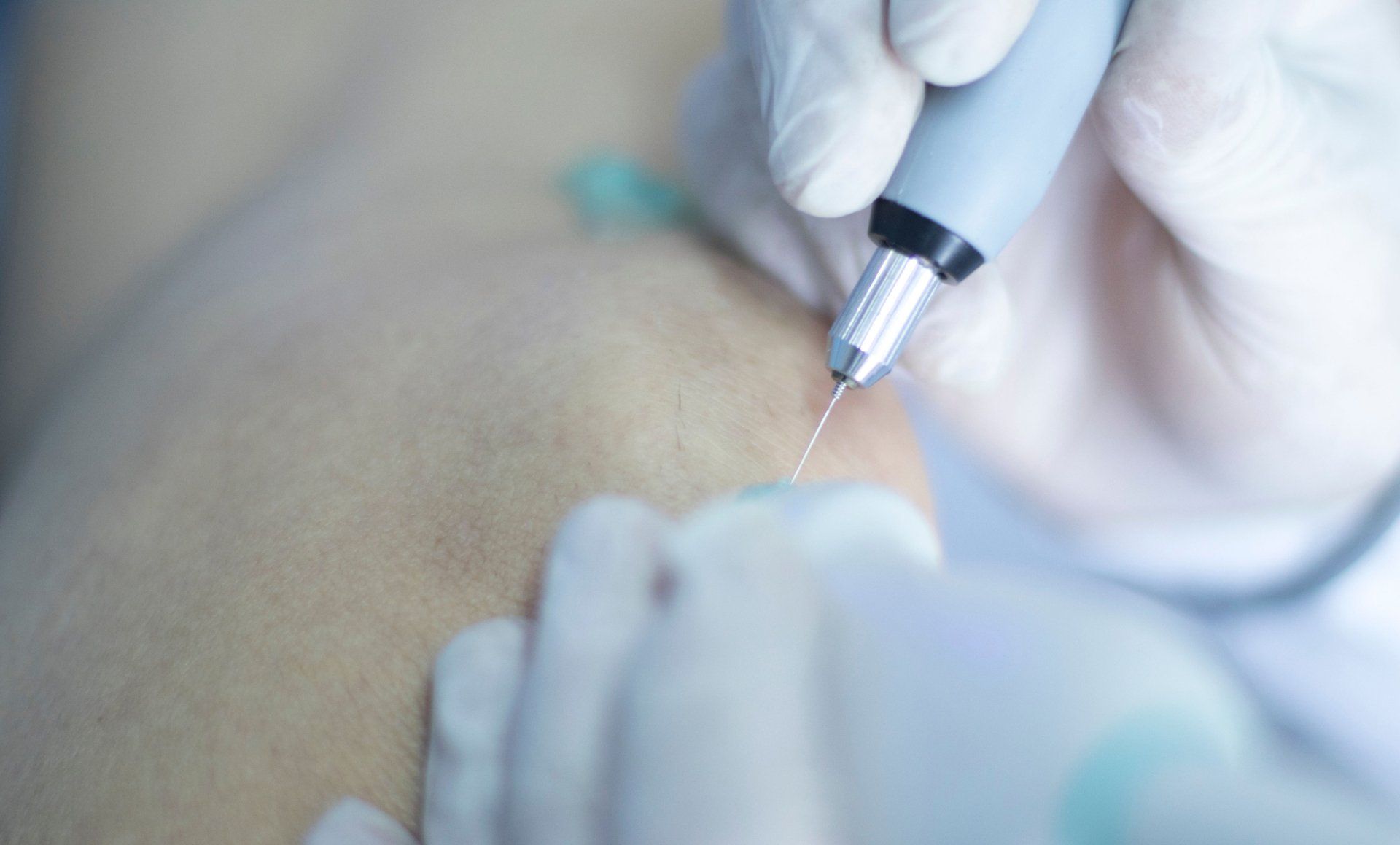 Close-up of a licensed professional performing electrolysis hair removal, using a precision probe