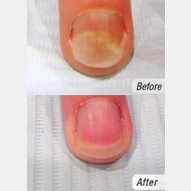 Laser Finger Nail Fungus Treatment