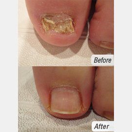 Laser Nail Fungus Treatment