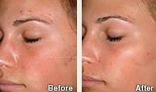 Laser Acne Scar Treatment