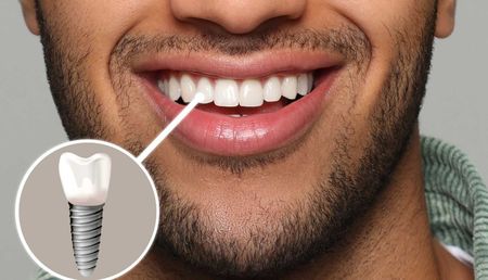 A man with a beard is smiling with a dental implant in his mouth.