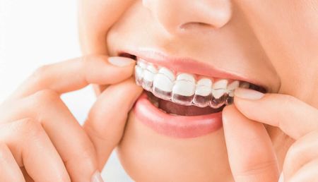 A woman is wearing invisible braces on her teeth.