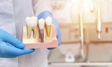 A dentist is holding a model of a dental implant.