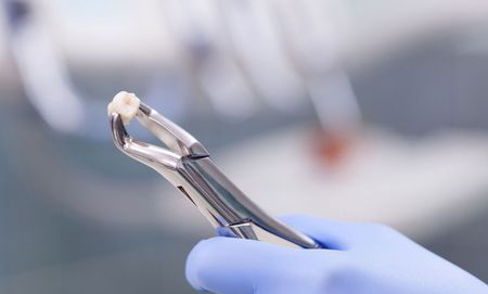 A dentist is holding a pair of dental pliers with a tooth in it.