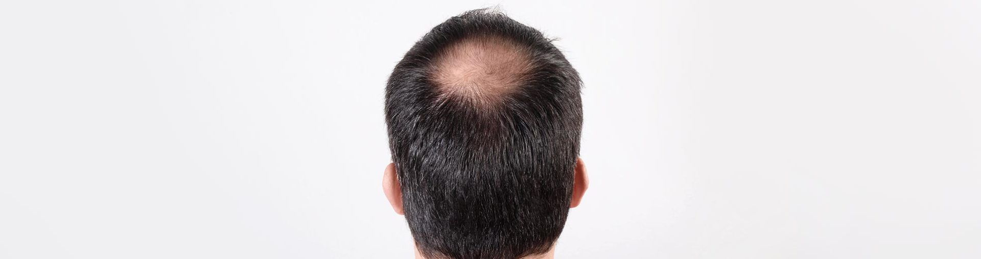 Hair replacement