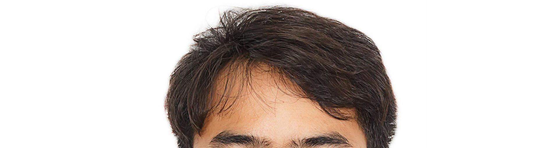 Hair replacement