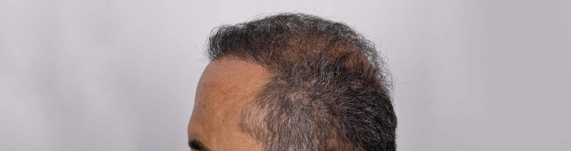 Hair replacement