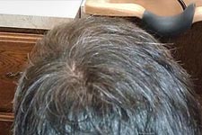 Hair replacement