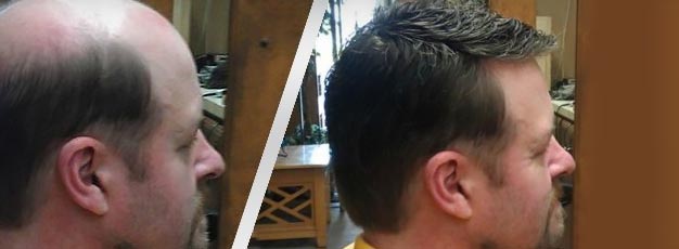 Hair replacement before/after