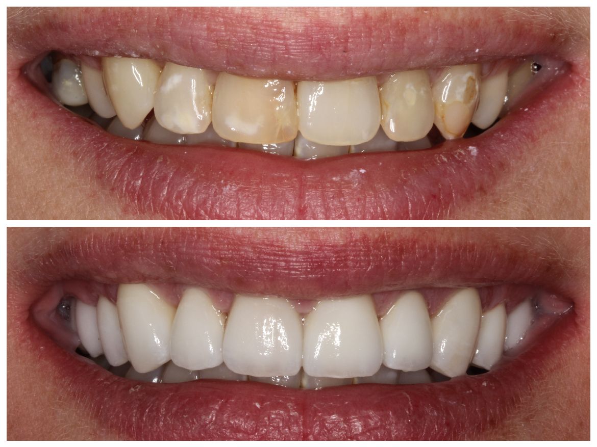 Before and after photos of a smile. Top: stained and chipped teeth. Bottom: bright, white, and even teeth.
