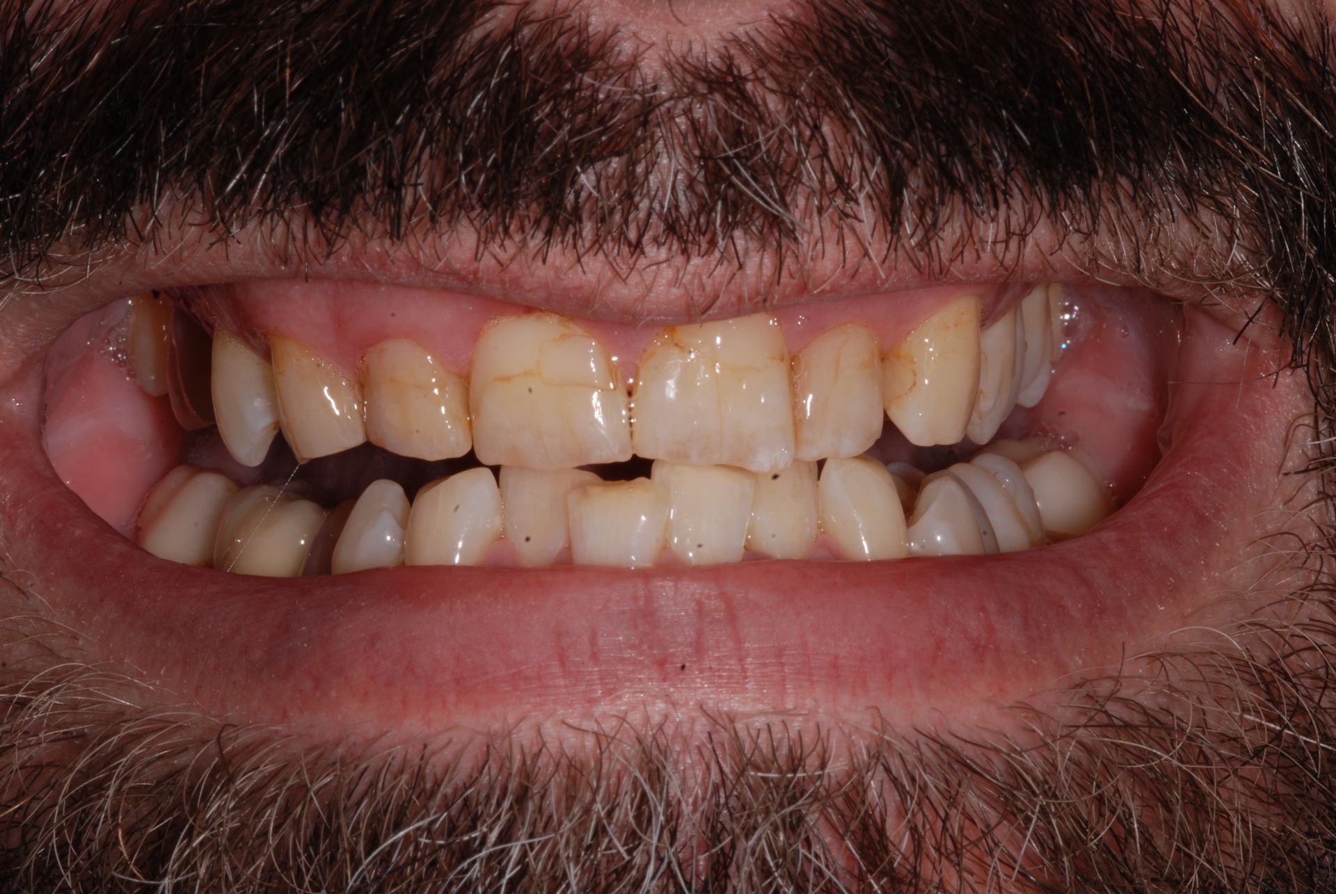 Close-up of a person's mouth showing teeth with noticeable discoloration, some gaps, and a broken front tooth.