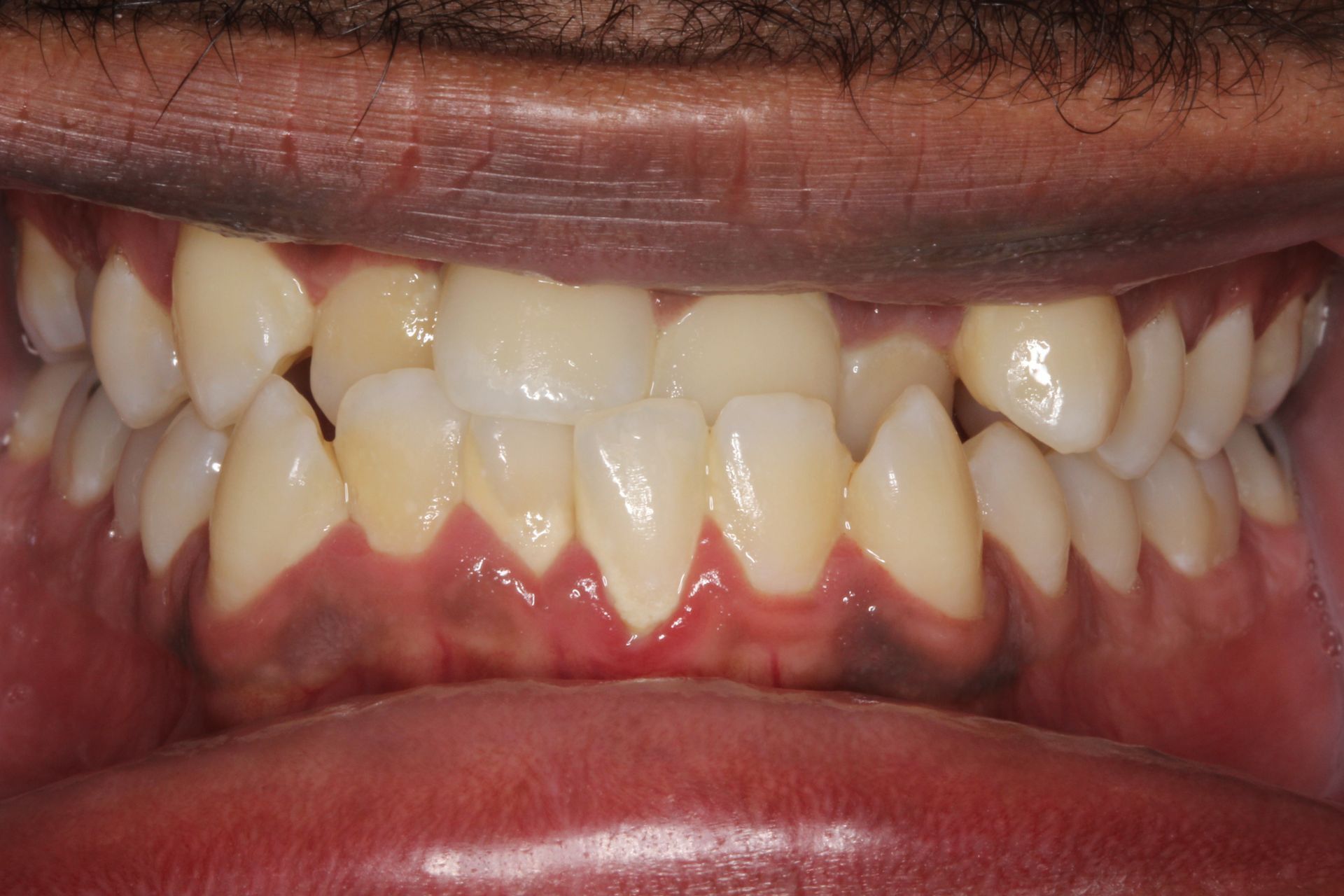 Close-up of a person's teeth showing crowding, yellowing, and inflamed gums.