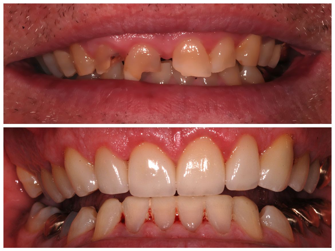 Top: Damaged teeth. Bottom: Restored, healthy teeth. Comparison of dental work.