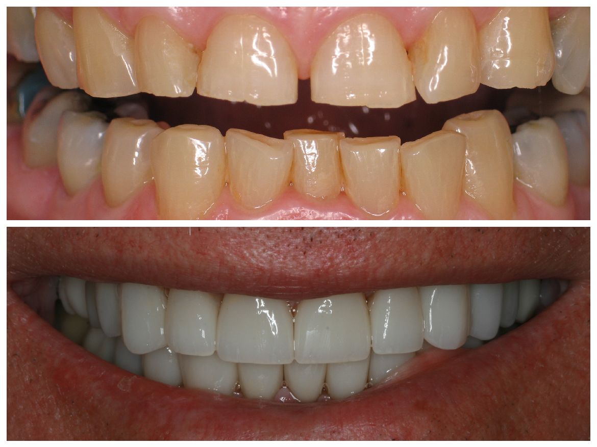 Before and after comparison of teeth. Upper teeth are yellow and uneven. Lower teeth are white and aligned.
