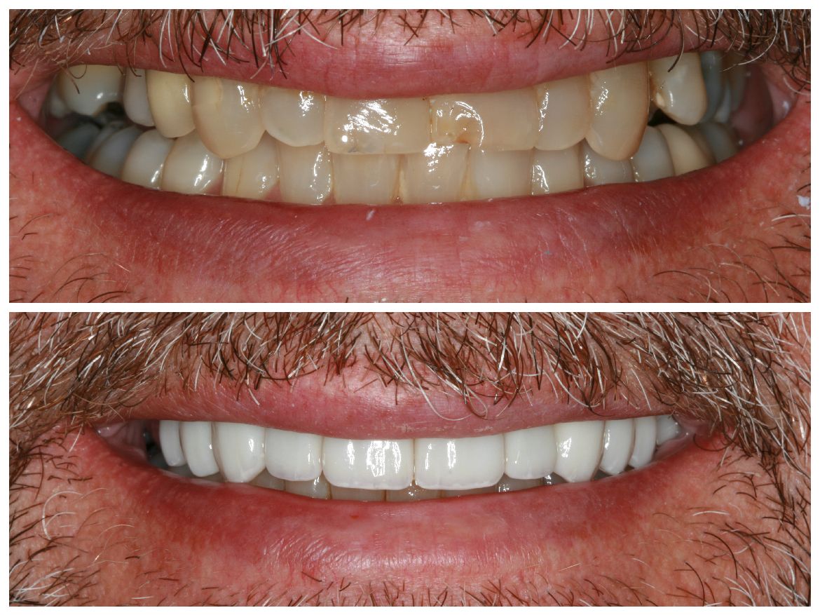 Comparison of teeth: top row shows stained teeth, bottom row shows bright white teeth.