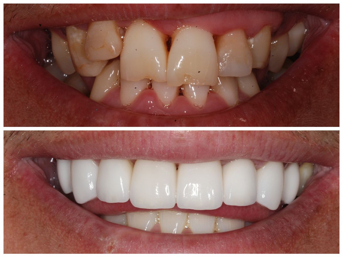 Comparison of teeth before and after cosmetic dentistry; showing alignment and color changes.