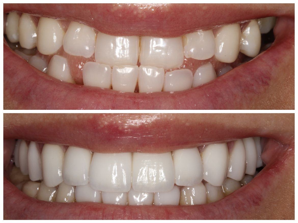 Side-by-side comparison: Cropped close-up showing before and after of a person's teeth, demonstrating cosmetic dental work.