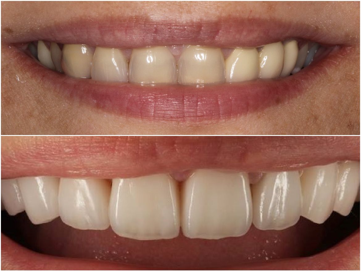 Top: Close-up of smiling teeth. Bottom: Close-up of even, bright white teeth.