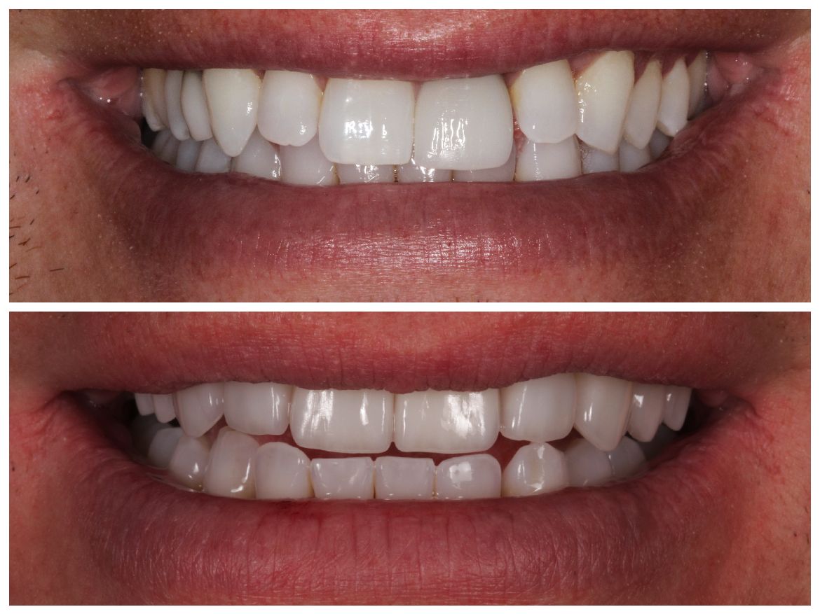 Side-by-side comparison of teeth; before (uneven) and after (straight, white), in a smiling mouth.
