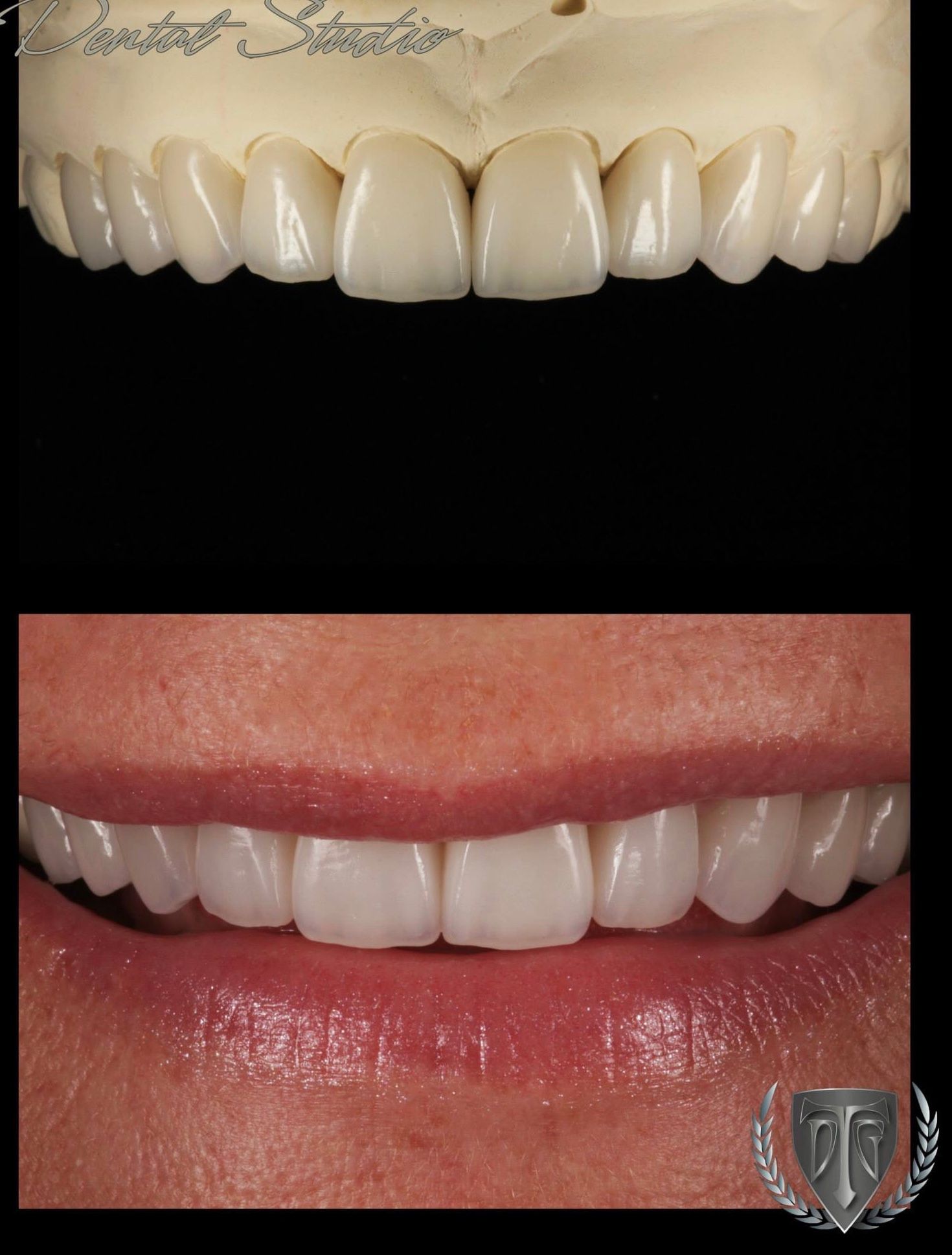 Comparison of dental veneers: mock-up on model above, smile with veneers below; white teeth, dark background.