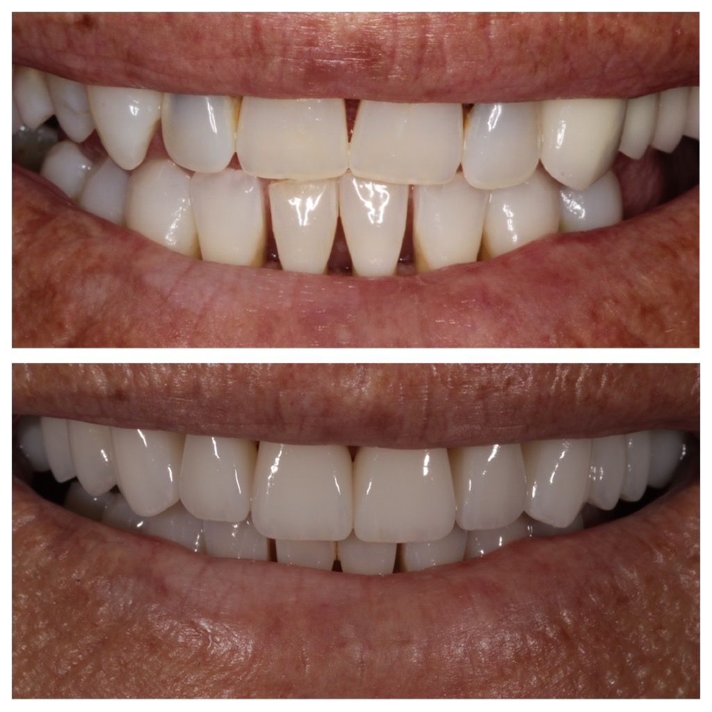 Top: Teeth with a gap. Bottom: Teeth with the gap closed.